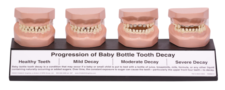 Progression of Baby Bottle Tooth Decay