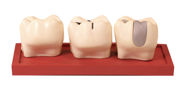 Molars with Restoration